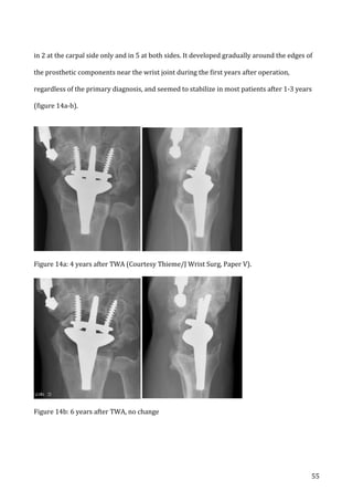   55	
  
in	
  2	
  at	
  the	
  carpal	
  side	
  only	
  and	
  in	
  5	
  at	
  both	
  sides.	
  It	
  developed	
  gradually	
  around	
  the	
  edges	
  of	
  
the	
  prosthetic	
  components	
  near	
  the	
  wrist	
  joint	
  during	
  the	
  first	
  years	
  after	
  operation,	
  
regardless	
  of	
  the	
  primary	
  diagnosis,	
  and	
  seemed	
  to	
  stabilize	
  in	
  most	
  patients	
  after	
  1-­‐3	
  years	
  
(figure	
  14a-­‐b).	
  	
  
	
  
	
   	
  
Figure	
  14a:	
  4	
  years	
  after	
  TWA	
  (Courtesy	
  Thieme/J	
  Wrist	
  Surg,	
  Paper	
  V).	
   	
   	
  
	
   	
  
Figure	
  14b:	
  6	
  years	
  after	
  TWA,	
  no	
  change	
  
	
  
 