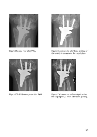   57	
  
	
  
Figure	
  15a:	
  one	
  year	
  after	
  TWA.	
  
	
  
	
  
Figure	
  15b:	
  PPO	
  seven	
  years	
  after	
  TWA.	
  	
  
	
  
Figure	
  15c:	
  six	
  weeks	
  after	
  bone	
  grafting	
  of	
  
the	
  osteolytic	
  area	
  under	
  the	
  carpal	
  plate	
  
	
  
	
  
	
  
Figure	
  15d:	
  recurrence	
  of	
  osteolysis	
  under	
  
the	
  carpal	
  plate,	
  2	
  years	
  after	
  bone	
  grafting.	
  
	
  
	
   	
  
 