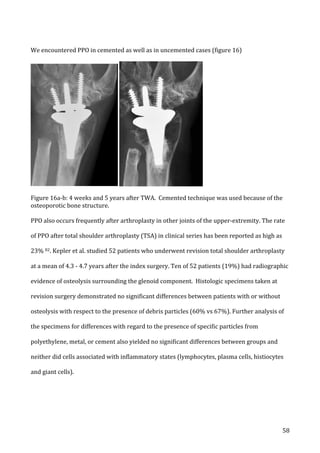   58	
  
We	
  encountered	
  PPO	
  in	
  cemented	
  as	
  well	
  as	
  in	
  uncemented	
  cases	
  (figure	
  16)	
  	
  
	
   	
  
Figure	
  16a-­‐b:	
  4	
  weeks	
  and	
  5	
  years	
  after	
  TWA.	
  	
  Cemented	
  technique	
  was	
  used	
  because	
  of	
  the	
  
osteoporotic	
  bone	
  structure.	
  
	
  
PPO	
  also	
  occurs	
  frequently	
  after	
  arthroplasty	
  in	
  other	
  joints	
  of	
  the	
  upper-­‐extremity.	
  The	
  rate	
  
of	
  PPO	
  after	
  total	
  shoulder	
  arthroplasty	
  (TSA)	
  in	
  clinical	
  series	
  has	
  been	
  reported	
  as	
  high	
  as	
  
23%	
  82.	
  Kepler	
  et	
  al.	
  studied	
  52	
  patients	
  who	
  underwent	
  revision	
  total	
  shoulder	
  arthroplasty	
  
at	
  a	
  mean	
  of	
  4.3	
  -­‐	
  4.7	
  years	
  after	
  the	
  index	
  surgery.	
  Ten	
  of	
  52	
  patients	
  (19%)	
  had	
  radiographic	
  
evidence	
  of	
  osteolysis	
  surrounding	
  the	
  glenoid	
  component.	
  	
  Histologic	
  specimens	
  taken	
  at	
  
revision	
  surgery	
  demonstrated	
  no	
  significant	
  differences	
  between	
  patients	
  with	
  or	
  without	
  
osteolysis	
  with	
  respect	
  to	
  the	
  presence	
  of	
  debris	
  particles	
  (60%	
  vs	
  67%).	
  Further	
  analysis	
  of	
  
the	
  specimens	
  for	
  differences	
  with	
  regard	
  to	
  the	
  presence	
  of	
  specific	
  particles	
  from	
  
polyethylene,	
  metal,	
  or	
  cement	
  also	
  yielded	
  no	
  significant	
  differences	
  between	
  groups	
  and	
  
neither	
  did	
  cells	
  associated	
  with	
  inflammatory	
  states	
  (lymphocytes,	
  plasma	
  cells,	
  histiocytes	
  
and	
  giant	
  cells).	
  	
  
 