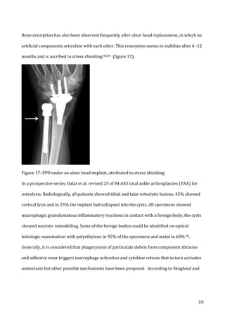   59	
  
Bone	
  resorption	
  has	
  also	
  been	
  observed	
  frequently	
  after	
  ulnar	
  head	
  replacement,	
  in	
  which	
  no	
  
artificial	
  components	
  articulate	
  with	
  each	
  other.	
  This	
  resorption	
  seems	
  to	
  stabilize	
  after	
  6	
  -­‐12	
  
months	
  and	
  is	
  ascribed	
  to	
  stress	
  shielding	
  83,84	
  	
  (figure	
  17).	
  
	
  
Figure	
  17:	
  PPO	
  under	
  an	
  ulnar	
  head	
  implant,	
  attributed	
  to	
  stress	
  shielding	
  
In	
  a	
  prospective	
  series,	
  Dalat	
  et	
  al.	
  revised	
  25	
  of	
  84	
  AES	
  total	
  ankle	
  arthroplasties	
  (TAA)	
  for	
  
osteolysis.	
  Radiologically,	
  all	
  patients	
  showed	
  tibial	
  and	
  talar	
  osteolytic	
  lesions,	
  45%	
  showed	
  
cortical	
  lysis	
  and	
  in	
  25%	
  the	
  implant	
  had	
  collapsed	
  into	
  the	
  cysts.	
  All	
  specimens	
  showed	
  
macrophagic	
  granulomatous	
  inflammatory	
  reactions	
  in	
  contact	
  with	
  a	
  foreign	
  body;	
  the	
  cysts	
  
showed	
  necrotic	
  remodelling.	
  Some	
  of	
  the	
  foreign	
  bodies	
  could	
  be	
  identified	
  on	
  optical	
  
histologic	
  examination	
  with	
  polyethylene	
  in	
  95%	
  of	
  the	
  specimens	
  and	
  metal	
  in	
  60%	
  85.	
  	
  
Generally,	
  it	
  is	
  considered	
  that	
  phagocytosis	
  of	
  particulate	
  debris	
  from	
  component	
  abrasive	
  
and	
  adhesive	
  wear	
  triggers	
  macrophage	
  activation	
  and	
  cytokine	
  release	
  that	
  in	
  turn	
  activates	
  
osteoclasts	
  but	
  other	
  possible	
  mechanisms	
  have	
  been	
  proposed:	
  	
  According	
  to	
  Skoglund	
  and	
  
 