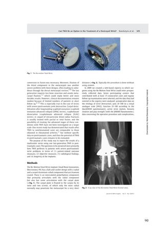   90	
  
	
  
	
   	
  
conversion to fusion was necessary. Moreover, ﬁxation of
the distal component in the metacarpals was another
severe problem with these designs, often leading to subsi-
dence through the dorsal metacarpal cortices.4–6
The last
generation requires less bone resection and avoids meta-
carpal ﬁxation,1,7
which could imply better and more
durable results. However, clinical documentation remains
modest because of limited numbers of patients or short
follow up.8–10
This is especially true in the case of wrists
with severe posttraumatic joint destruction. Carpal desta-
bilization after longstanding scaphoid nonunion (scaphoid
nonunion advanced collapse [SNAC] wrists), scapholunate
dissociation (scapholunate advanced collapse [SLAC]
wrists), or sequel of intraarticular distal radius fractures
is usually treated with partial or total fusion, and the
possibility of treating the advanced stages of these con-
ditions with TWA have not been investigated on a larger
scale. One recent study has demonstrated that results after
TWA in nonrheumatoid cases are comparable to those
obtained in rheumatoid arthritis,11
but without speciﬁc
data on posttraumatic cases, and thus the potential of TWA
in posttraumatic cases remains to be evaluated.
The purpose of this study was to report the results of a
multicenter series using one last-generation TWA in post-
traumatic cases. The questions to be answered were primarily
how TWA performs in patients with severe posttraumatic
wrist problems in terms of (1) patient-related outcome
measures, (2) objective measures, (3) radiological ﬁndings,
and (4) longevity of the implants.
Methods
The Re-Motion Total Wrist implant (Small Bone Innovation,
Morristown, PA) has a ball-and-socket design with a radial
and a carpal chromium-cobalt component that are titanium
coated. There is an intercalated polyethylene component
that primarily articulates with the radial component
but also has some articulation with the carpal plate
(►Fig. 1). The carpal plate is ﬁxated to the carpus by its
stem and two screws, of which only the most radial
normally may penetrate the metacarpal for a very short
distance (►Fig. 2). Typically the procedure is done without
using cement.
In 2009 we created a web-based registry in which sur-
geons using the Re-Motion Total Wrist could enter prospec-
tively collected data. Seven participating centers that
contributed with at least 15 consecutive cases and regular
follow-up examinations were selected, and the data they had
entered in the registry were analyzed: preoperative data on
the etiology of wrist destruction, pain (0–100 on a visual
analogue scale [VAS]), function (0–100 according to the
QuickDASH questionnaire), active wrist motion, forearm
rotation and grip strength (with the JAMAR Dynamometer),
data concerning the operative procedure and complications,
Fig. 1 The Re-motion Total Wrist.
Fig. 2 X-ray view of the Re-motion Total Wrist (frontal view).
Journal of Wrist Surgery Vol. 2 No. 4/2013
Can TWA Be an Option in the Treatment of a Destroyed Wrist? Boeckstyns et al. 325
Downloadedby:MichelBoeckstyns.Copyrightedmaterial.
 