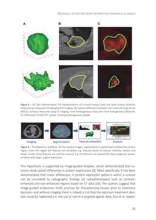 RADIOMICS: EXTRACTING MORE INFORMATION FROM MEDICAL IMAGES
35
Figure 3 – (A) Two representative 3-D representations of a round tumour (top) and spiky tumour (bottom)
measured by computed tomography (CT) imaging. (B) Texture differences between non-small cell lung cancer
(NSCLC) tumours measured using CT imaging, more heterogeneous (top) and more homogeneous (bottom).
(C) Differences of FDG-PET uptake, showing heterogeneous uptake.
Figure 4 – The Radiomics workflow. On the medical images, segmentation is performed to define the tumour
region. From this region the features are extracted, e.g. features based on tumour intensity, texture and
shape. Finally, these features are used for analysis, e.g. the features are assessed for their prognostic power,
or linked with stage, or gene expression.
This hypothesis is supported by image-guided biopsies, which demonstrated that tu-
mours show spatial differences in protein expressions [9]. More specifically, it has been
demonstrated that major differences in protein expression patterns within a tumour
can be correlated to radiographic findings (or radiophenotypes) such as contrast-
enhanced and non-enhanced regions based on CT data [10]. The authors suggest that
image-guided proteomics holds promise for characterising tissues prior to treatment
decisions and without imaging there is indeed a risk that the optimum treatment deci-
sion could be neglected (i.e. the use or not of a targeted agent). Also, Kuo et al. report-
 