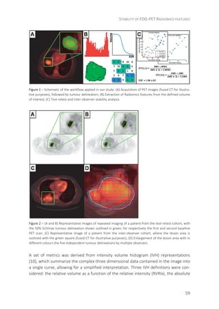 STABILITY OF FDG-PET RADIOMICS FEATURES
59
Figure 1 – Schematic of the workflow applied in our study: (A) Acquisition of PET images (fused CT for illustra-
tive purposes), followed by tumour delineation; (B) Extraction of Radiomics features from the defined volume
of interest; (C) Test-retest and inter-observer stability analysis.
Figure 2 – (A and B) Representative images of repeated imaging of a patient from the test-retest cohort, with
the 50% SUVmax tumour delineation shown outlined in green, for respectively the first and second baseline
PET scan. (C) Representative image of a patient from the inter-observer cohort, where the lesion area is
outlined with the green square (fused CT for illustrative purposes); (D) Enlargement of the lesion area with in
different colours the five independent tumour delineations by multiple observers.
A set of metrics was derived from intensity volume histogram (IVH) representations
[10], which summarize the complex three dimensional data contained in the image into
a single curve, allowing for a simplified interpretation. Three IVH definitions were con-
sidered: the relative volume as a function of the relative intensity (RVRIx), the absolute
 