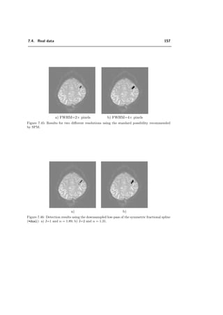 7.3. Which properties of the wavelet transform are preferable for fMRI? 133
wavelet coeﬃcients along 16 diﬀerent input signals. For the ﬁrst iteration, the
Complex Daubechies stay invariant. For higher iterations, their shift invariance
decreases.
→ High noise. Another experiment, presented in Figure 7.24, shows the better shift-
invariance for the complex Daubechies by detecting ellipses which are at equally
spaced ﬁxed positions (Figure 7.22). The shift-variance is more prominent as the
noise is larger (here −9.3 dB). The error E(n) = E1(n)+E2(n) is measured, which
depends on the order n of the wavelets. In Figure 7.24 this error is illustrated
quantitatively for all n for two diﬀerent set of data, which diﬀer only by a shift of
the ellipses. Obviously the results for daub change depending on the shift of the
ellipses. In the case of the complex Daubechies (complex) the results remain very
similar. However, the minimal error E(n) is only slightly better for the complex
case compared to the real Daubechies ﬁlter. Typically, for a very high noise like
in this example, the complex Daubechies do not perform better, although complex
detects more ellipses than daub, as it can be seen in Figure 7.23.
→ Medium level of noise. With lower amount of noise, 5dB ≤ SNR ≤ 10dB the
shift variance of the real wavelets loses its inﬂuence on the results of detection. A
remarkable result with lower amount of noise, same realization than in Figure 7.22
b), is the performance of complex for detection compared to daub. The complex
Daubechies outperform the real Daubechies by far, as shown in Figure 7.25 b).
But also compared to other wavelets like the fractional spline wavelets, presented
in Section 7.3.4, the complex Daubechies show good results, as presented in Fig-
ure 7.25. The larger the activation pattern, the better the result of complex.
→ Low level of noise. Very low noise, SNR  10 dB for ¯ID yields increased E1
errors and thus, the performance of complex decreases. However it still gives
results comparable to daub. In Figure 7.26 an example is presented where the
test data is illustrated in Figure 7.12 b). In this example, the complex Daubechies
and the dual fractional spline wavelets give the best result, see Figure 7.26 and
table in Figure 7.1. Independently of the noise level, the number of detected
wavelet coeﬃcients count is always much higher than in the case of daub, as can
be seen in Figure 7.27 a). count for complex is often higher than for dual, when
the degree α of dual is less than 2. These many detections yield a low E2 error.
Thus complex tends to detect more pixels rightly, but at the cost of more false
detections than in the case of real Daubechies (compare Figure 7.27). Figure 7.28
shows these detection results qualitatively. The detection count in the high-pass
are also relatively frequent. complex detects more in the high-pass than daub and
also dual.
 