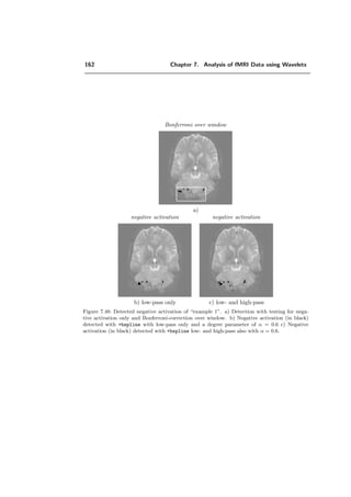 138 Chapter 7. Analysis of fMRI Data using Wavelets
2 4 6 8
50
55
60
65
70
75
80
85
order n
count(n)
complex
daub
2 4 6 8
0
10
20
30
40
50
order n
falsedetectionsE1(n)
complex
daub
2 4 6 8
0
10
20
30
40
50
order n
misseddetectionsE2(n)
complex
daub
a) C b) E1 c) E2
Figure 7.27: Illustration of wavelet count C, E1 and E2 corresponding to the detection with the
same data like in Figure 7.26. count(α) is always higher for complex than for daub (a). For this
reason, the missed detections E2 are usually much smaller for complex (c). On the contrary the
false detections E1 are higher for complex (b).
orthogonal fractional spline ﬁlter Bα
∗ortho with α = λ − 1 as shown below:
Hλ(ω) =
√
2(2 + 2 cos ω)
λ
2
(2 + 2 cos ω)λ + (2 − 2 cosω)λ
=
√
2 cos ω
2
λ
cos ω
2
2λ
+ sin ω
2
2λ
(7.6)
whereas
Bα
∗ortho(ω) =
√
2
1 + e−jω
2
α+1
Aα(ω)
Aα(2ω)
=
√
2 cos
ω
2
α+1 Aα(ω)
Aα(2ω)
. (7.7)
Call that the autocorrelation ﬁlter A(ω) satisﬁes ([135]) the two-scale relation:
A(2ω) =
1
2
|Bα
∗ (ω)|2
A(ω) +
1
2
|Bα
∗ (ω + π)|2
A(ω + π).
(7.8)
 