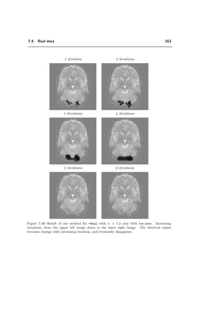 7.3. Which properties of the wavelet transform are preferable for fMRI? 139
daub complex
+bspline +ortho +dual
Figure 7.28: Detection of the activation pattern of Figure 7.12 b) with SNR = −1.19 dB. The
corresponding error and degree parameter α is given in the table of Figure 7.1. complex and
+dual detect obviously the best: there are not many visible missed detections.
 