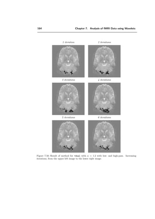 140 Chapter 7. Analysis of fMRI Data using Wavelets
A way to compute A(ω) is to iterate the following process (ensured to converge if φ ∈ L2
and if φ is a Riesz basis):
Ai+1(2ω) =
1
2
|H(ω)|2
Ai(ω) +
1
2
|H(ω + π)|2
Ai(ω + π),
starting with A0(ω) = 1. The convergence speed of this scheme is directly given by the
Sobolev regularity of φ: higher regularity, faster convergence. The ﬁlter
Ai(ω)
Ai+1(2ω)
Bα
∗ (ω)
automatically satisﬁes the orthogonality relation and the ﬁrst iteration gives (7.6) while
the inﬁnite iteration gives (7.7) if we identify λ = α + 1. For α = 0 and λ = 1 the ﬁlters
are exactly the same. For 0  α 2, their diﬀerence increases and for a higher degree
parameter (α 2) , the ﬁlters match again better, which illustrates Figure 7.29.
The frequency response of Hλ(ω), called sep is depicted in Figure 7.30 for the order
λ = 2 and λ = 6. The nonseparable ﬁlter for the quincunx transform is called quin and
is depicted in Figure 7.31.
In fMRI, the activation zones can be very small, compared to the size of the volumes
or images taken from the brain. This is illustrated in Figure 7.32. One limitation of
the separable wavelets is the scale progression by powers of 2 only. Thus the number of
coeﬃcients of the low-pass which represents mainly the activation zones is reduced by 4
with every iteration, as presented in Figure 7.33 upper row. To detect more accurately
small patterns, a ﬁner scale progression would be preferable.
The second drawback of the separable wavelets is the strong directionality of the ﬁlters.
Thus the separable wavelets detect more easily horizontal and vertical expanded pat-
terns, whereas the activation zones can have any directionality. To reduce this problem,
nonseparable wavelets are more appropriate.
The quincunx transform is a solution to these issues: the scale progresses by powers of√
2 and provides thus a bandpass of ﬁner resolution than in the separable case; moreover,
the ﬁltering is less directional, which was made possible because of the non-separability of
the ﬁlters. We developed a fast FFT-based implementation for two and three dimensions,
refer to Chapter 5.
→ Detection accuracy. We devised an experiment with a single pattern, scattered
over the size of the image, to which a noise of SNR = 2.5 dB for IDτ (x, y), respec-
tively SNR = 15.5 dB for ¯ID(x, y) has been added. The corresponding test image
I(x, y) is shown in Figure 7.34. Both algorithms, the quincunx transform with its
fractional ﬁlter quin and the separable algorithm with the corresponding separable
ﬁlters were applied to I(x, y). This is a typical example where quin detects more
accurately, even though the patterns have a rather horizontal extension, which
should favor separable wavelets. A qualitative detection is illustrated in Figure
 