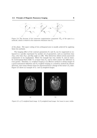 2.2. Principle of Magnetic Resonance Imaging 9
x
y
z
xyM
M z
x
y
z
xyM
M z
xyM
M z
x
y
z
Figure 2.4: The decrease of the transverse magnetization component Mxy of the spins in a
molecule, which is related to the transverse relaxation time T2.
of the phase. The space coding of two orthogonal axes is usually achieved by applying
these two methods.
The imaging eﬀect of the contrast parameters T1 and T2 can be suppressed or en-
hanced in a speciﬁc experiment by another set of parameters, such as repetition time
(TR), echo time (TE), and ﬂip angle (α) [90]. This distinction allows certain structural
components to be emphasized. Water for example has very similar T1 and T2 times.
In cerebrospinal ﬂuid (CSF) T1 is larger than T2, and in white matter the diﬀerence is
even greater. Therefore, T1-weighted imaging is an eﬀective method to obtain images of
a good anatomical deﬁnition and T2-weighted imaging is a sensitive method for disease
detection, since many disease states are characterized by a change of the tissue’s T2 value.
Figure 2.5 shows an example of T1- and T2-weighted images.
a) b)
Figure 2.5: a) T1-weighted head image. b) T2-weighted head image: the tumor is more visible.
 