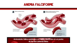 Anemia falciformeAminoácido Valina sustituye a un Ácido Glutámico en un punto de las dos cadenas Beta.  