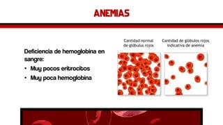 anemias 
Deficiencia de hemoglobina en sangre: 
•Muy pocos eritrocitos 
•Muy poca hemoglobina  