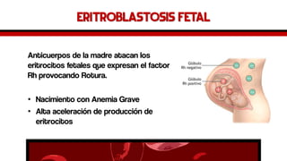 EritroblastosisFetal 
Anticuerpos de la madre atacan los eritrocitos fetales que expresan el factor Rh provocando Rotura. 
•Nacimiento con Anemia Grave 
•Alta aceleración de producción de eritrocitos  