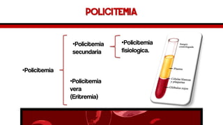 policitemia 
•Policitemia 
•Policitemiasecundaria 
•Policitemiavera(Eritremia) 
•Policitemiafisiologica.  