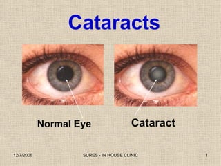 Cataract Normal Eye Cataracts 