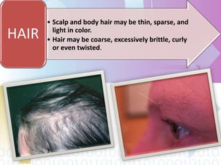 • Scalp and body hair may be thin, sparse, and
light in color.
• Hair may be coarse, excessively brittle, curly
or even twisted.
HAIR
 