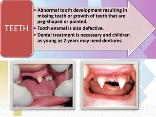 • Abnormal tooth development resulting in
missing teeth or growth of teeth that are
peg-shaped or pointed.
• Tooth enamel is also defective.
• Dental treatment is necessary and children
as young as 2 years may need dentures.
TEETH
 