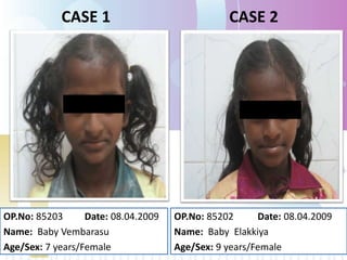 CASE 1
OP.No: 85203 Date: 08.04.2009
Name: Baby Vembarasu
Age/Sex: 7 years/Female
CASE 2
OP.No: 85202 Date: 08.04.2009
Name: Baby Elakkiya
Age/Sex: 9 years/Female
 