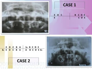 E D C B C D E
E C D E
E D C B A 1e B C D E
6e E D C B A A B C D E 6e
CASE 1
CASE 2
 