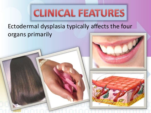Ectodermal Dysplasia Syndrome