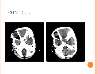 Suprasellar mass  ct scan of a child  Slide 11