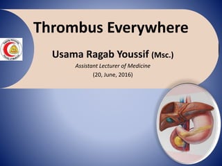 Thrombus Everywhere
Usama Ragab Youssif (Msc.)
Assistant Lecturer of Medicine
(20, June, 2016)
 