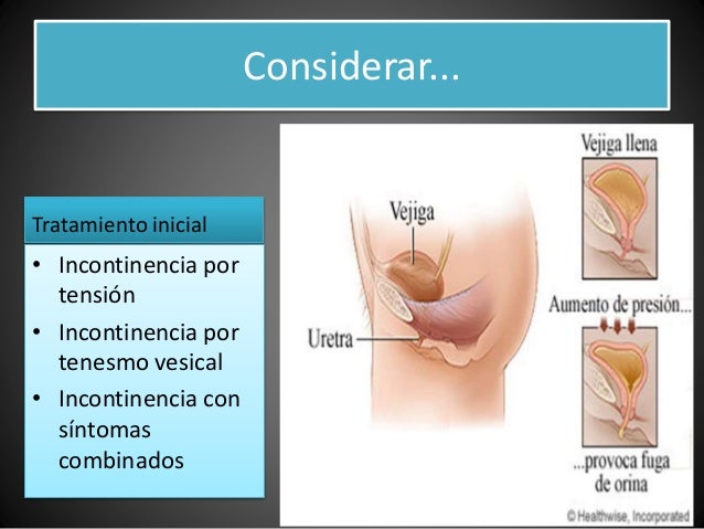 Incontinencia Urinaria Incontinencia Urinaria