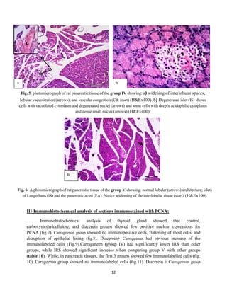 12
III-Immunohistochemical analysis of sections immunostained with PCNA:
Immunohistochemical analysis of thyroid gland showed that control,
carboxymethylcellulose, and diacerein groups showed few positive nuclear expressions for
PCNA (fig.7). Carrageenan group showed no immunopositive cells, flattening of most cells, and
disruption of epithelial lining (fig.8). Diacerein+ Carrageenan had obvious increase of the
immunolabeled cells (Fig.9).Carraganeen (group IV) had significantly lower IRS than other
groups, while IRS showed significant increase when comparing group V with other groups
(table 10). While, in pancreatic tissues, the first 3 groups showed few immunolabelled cells (fig.
10). Carageenan group showed no immunolabeled cells (fig.11). Diacerein + Carrageenan group
c
c
c
b
IS
a
Fig. 5: photomicrograph of rat pancreatic tissue of the group IV showing: a) widening of interlobular spaces,
lobular vacuolization (arrows), and vascular congestion (C& inset) (H&Ex400). b) Degenerated islet (IS) shows
cells with vacuolated cytoplasm and degenerated nuclei (arrows) and some cells with deeply acidophilic cytoplasm
and dense small nuclei (arrows) (H&Ex400).
Fig. 6: A photomicrograph of rat pancreatic tissue of the group V showing: normal lobular (arrows) architecture; islets
of Langerhans (lS) and the pancreatic acini (PA). Notice widinning of the interlobular tissue (stars) (H&Ex100).
PA
6
 