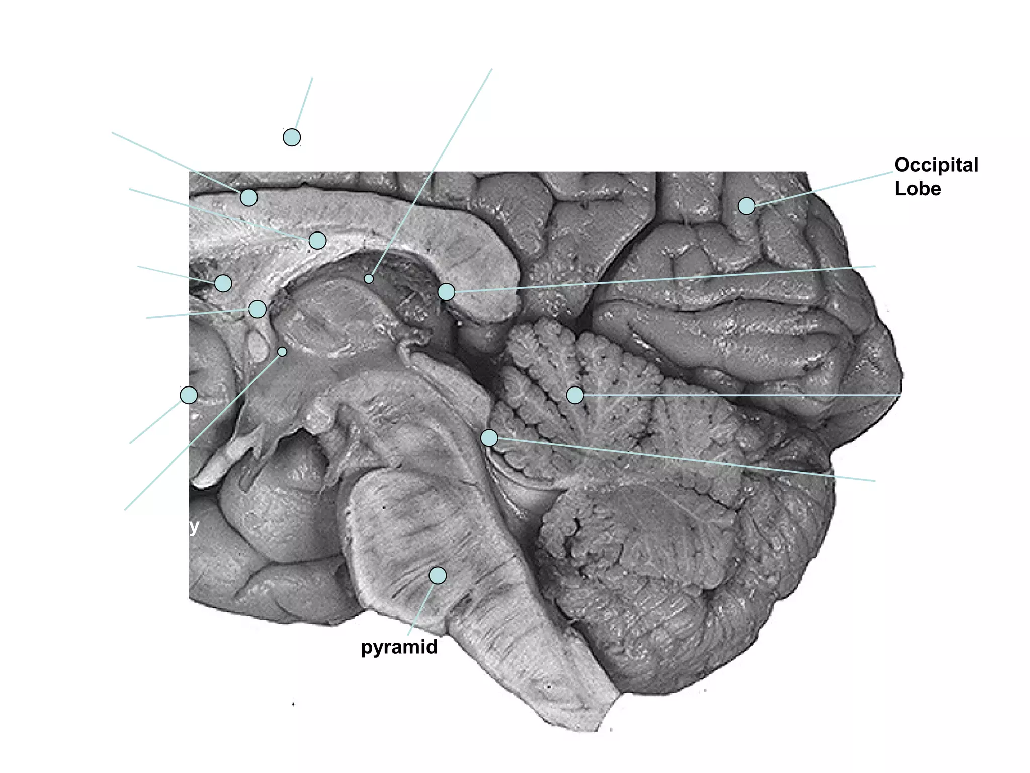 vermis
Occipital
LobeThalamus
Corpus callosum
Hypothalamus
Fornix
Anterior
commissure
Optic nerve
4th
ventricle
Posterior commissure
pyramid
Mammillary body
Quadrigeminal
cistern
 