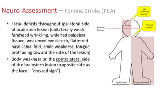 • Facial deficits throughout ipsilateral side
of brainstem lesion (unilaterally weak
forehead wrinkling, widened palpebral
fissure, weakened eye clench, flattened
naso-labial fold, smile weakness, tongue
protruding toward the side of the lesion)
• Body weakness on the contralateral side
of the brainstem lesion (opposite side as
the face …“crossed sign”)
Neuro Assessment – Pontine Stroke (PCA) NO
“Forehead
Sparing”
“Crossed
Findings”
Ipsilateral Contralateral
Bottom
of eyes
Stroke
 