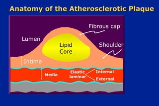 Anatomy of the Atherosclerotic PlaqueAnatomy of the Atherosclerotic Plaque
Lumen
Lipid
Core
Fibrous cap
Shoulder
Intima
Media
Elastic
laminæ
Internal
External
 