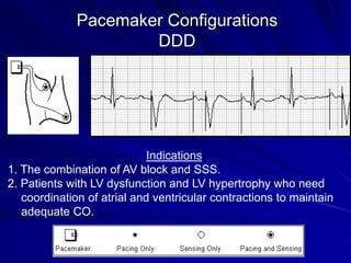 0 pacemakers and icds an overview-samir rafla-shorta conference | PDF