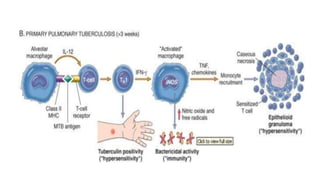 Pathophysiology and clinical management of tuberculosis | PPTX