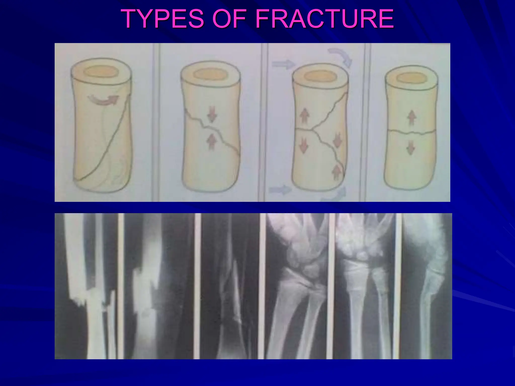 TYPES OF FRACTURE
 