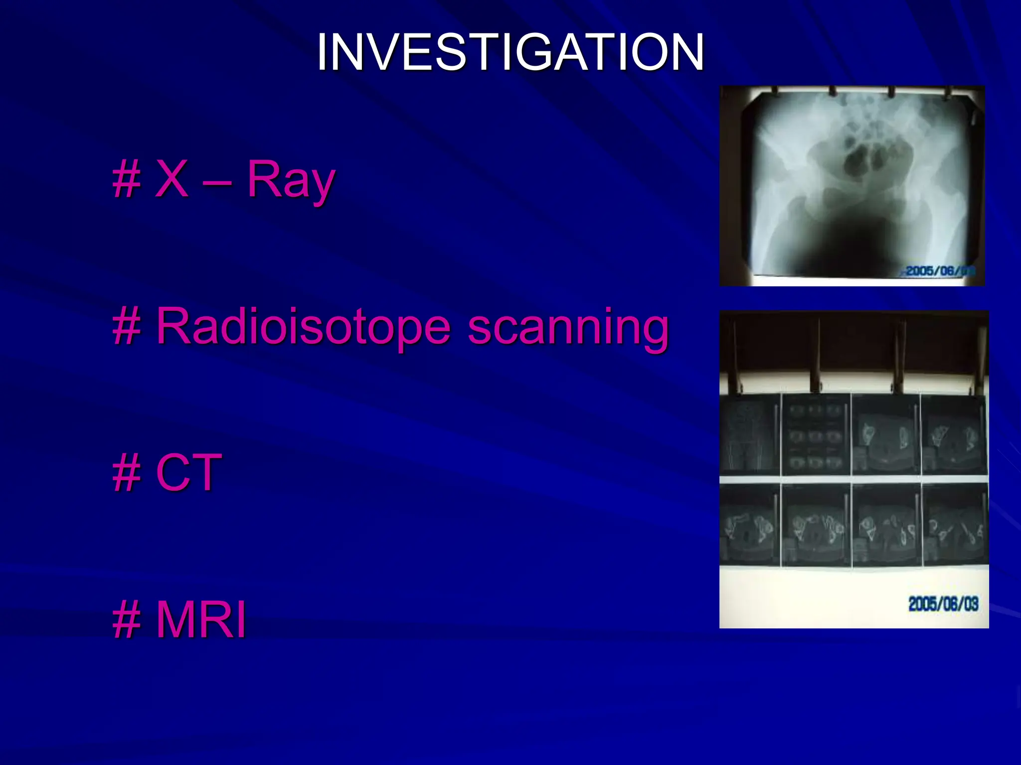 INVESTIGATION
# X – Ray
# Radioisotope scanning
# CT
# MRI
 