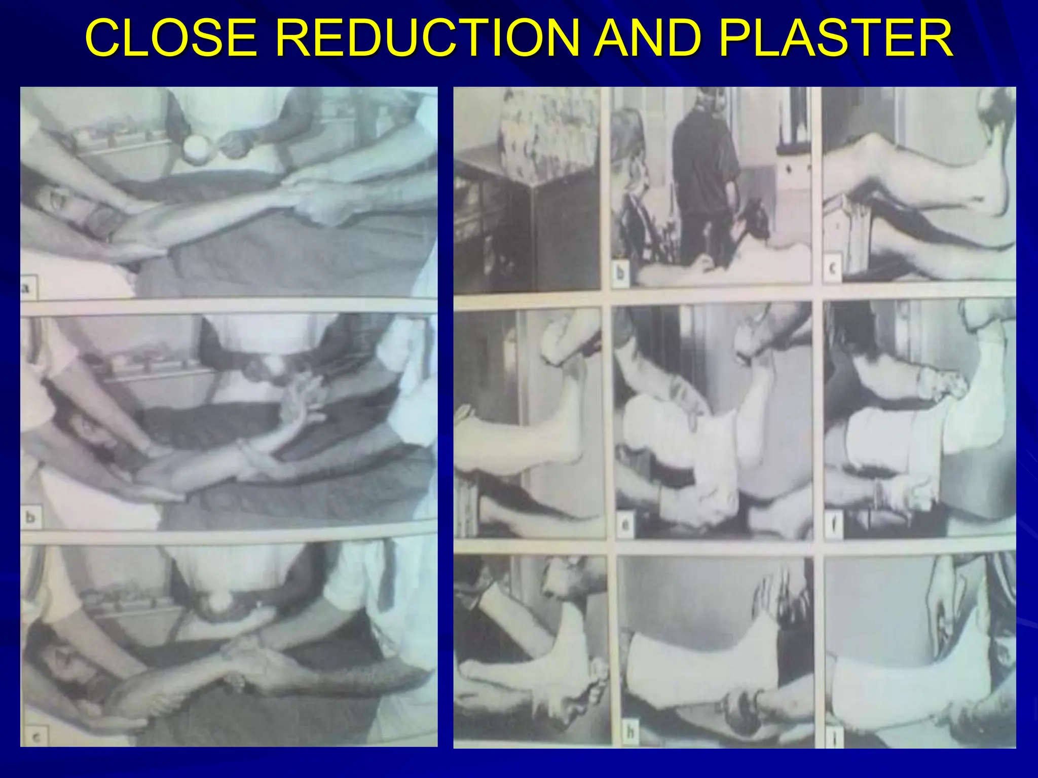 CLOSE REDUCTION AND PLASTER
 