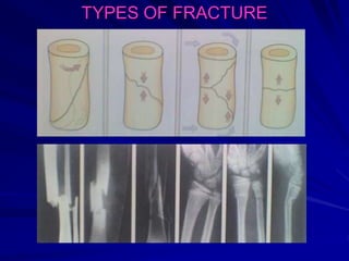 TYPES OF FRACTURE
 