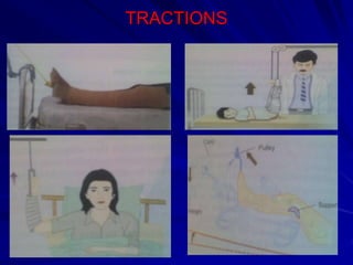 TRACTIONS
 