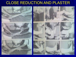 CLOSE REDUCTION AND PLASTER
 