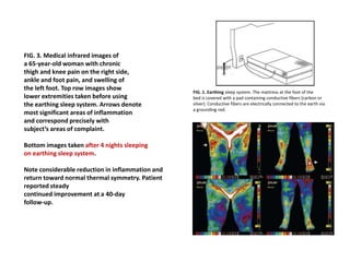 FIG. 3. Medical infrared images of
a 65-year-old woman with chronic
thigh and knee pain on the right side,
ankle and foot pain, and swelling of
the left foot. Top row images show
lower extremities taken before using
the earthing sleep system. Arrows denote
most significant areas of inflammation
and correspond precisely with
subject’s areas of complaint.
Bottom images taken after 4 nights sleeping
on earthing sleep system.
Note considerable reduction in inflammation and
return toward normal thermal symmetry. Patient
reported steady
continued improvement at a 40-day
follow-up.
FIG. 1. Earthing sleep system. The mattress at the foot of the
bed is covered with a pad containing conductive fibers (carbon or
silver). Conductive fibers are electrically connected to the earth via
a grounding rod.
 