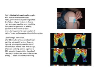 FIG. 5. Medical infrared imaging results
with a 33-year-old woman who
had a gymnastics injury at the age of 15.
She had an 18-year history of chronic
right knee pain, swelling, and instability.
Top row of images taken in walking
position to show inside of both
knees. Arrow points to exact location of
patient’s pain and shows significant inflammation.
Lower images were taken
after 30 minutes of exposure to clinical
earthing using patch system shown in
Figure 4. Note significant reduction of
inflammation in knee area. After 6 days
of clinical earthing, patient reported a
50% reduction in pain. After 4 weeks of
treatment, patient was able to play soccer,
and by 12 weeks she went waterskiing
 