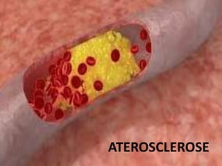 ATEROSCLEROSE
 