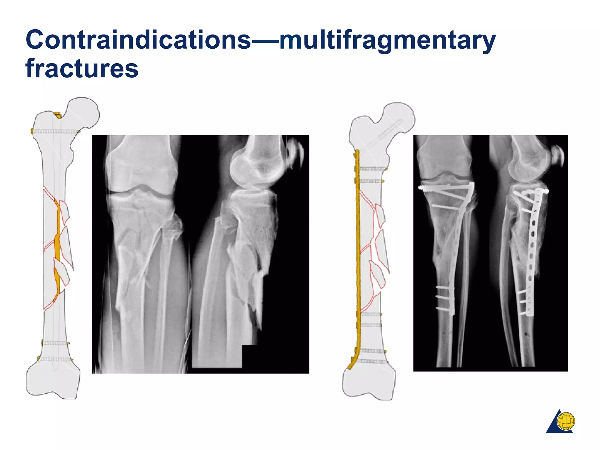 Biomechanics and biology of absolute stability | PPT