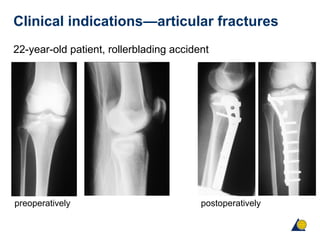 Biomechanics and biology of absolute stability | PPT
