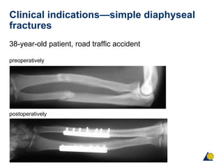 Biomechanics and biology of absolute stability | PPT