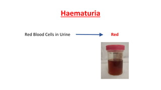 haematuria-pptx