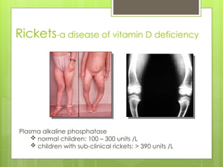 Rickets Graph Biochemistry of bone formation and degradation | PPT