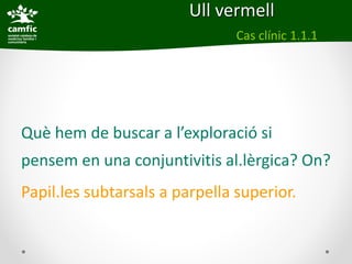 Ull vermell
                                Cas clínic 1.1.1




Què hem de buscar a l’exploració si
pensem en una conjuntivitis al.lèrgica? On?
Papil.les subtarsals a parpella superior.
 