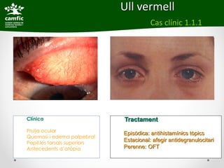 Ull vermell
                                         Cas clínic 1.1.1




Clínica                       Tractament
Pruïja ocular
                              Episòdica: antihistamínics tòpics
Quemosi i edema palpebral
Papil.les tarsals superiors
                              Estacional: afegir antidegranulocitari
Antecedents d’atòpia          Perenne: OFT
 