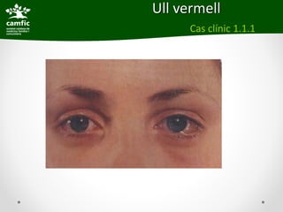 Ull vermell
      Cas clínic 1.1.1
 