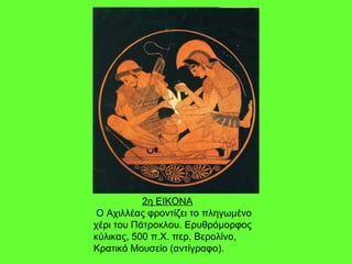 2η ΕΙΚΟΝΑ Ο Αχιλλέας φροντίζει το πληγωμένο χέρι του Πάτροκλου. Ερυθρόμορφος κύλικας, 500 π.Χ. περ. Βερολίνο, Κρατικό Μουσείο (αντίγραφο). 