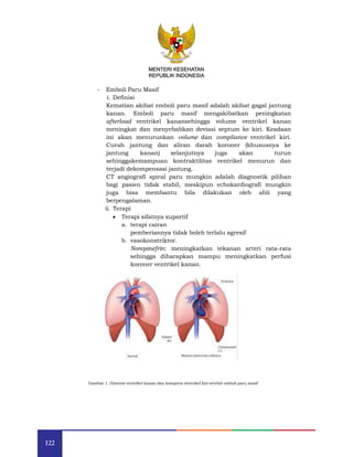 122
MENTERI KESEHATAN
REPUBLIK INDONESIA
- Emboli Paru Masif
i. Definisi
Kematian akibat emboli paru masif adalah akibat gagal jantung
kanan. Emboli paru masif mengakibatkan peningkatan
afterload ventrikel kanansehingga volume ventrikel kanan
meningkat dan menyebabkan deviasi septum ke kiri. Keadaan
ini akan menurunkan volume dan compliance ventrikel kiri.
Curah jantung dan aliran darah koroner (khususnya ke
jantung kanan) selanjutnya juga akan turun
sehinggakemampuan kontraktilitas ventrikel menurun dan
terjadi dekompensasi jantung.
CT angiografi spiral paru mungkin adalah diagnostik pilihan
bagi pasien tidak stabil, meskipun echokardiografi mungkin
juga bisa membantu bila dilakukan oleh ahli yang
berpengalaman.
ii. Terapi
 Terapi sifatnya suportif
a. terapi cairan
pemberiannya tidak boleh terlalu agresif
b. vasokonstriktor.
Norepinefrin: meningkatkan tekanan arteri rata-rata
sehingga diharapkan mampu meningkatkan perfusi
koroner ventrikel kanan.
Gambar 1. Distensi ventrikel kanan dan kompresi ventrikel kiri setelah emboli paru masif
 